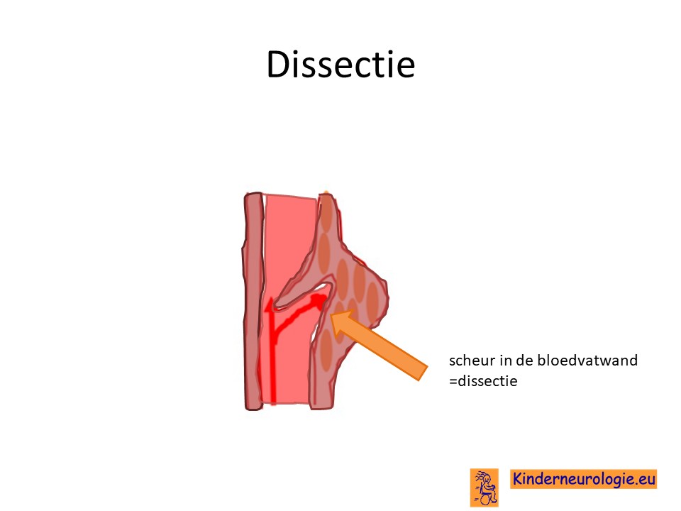 dissectie